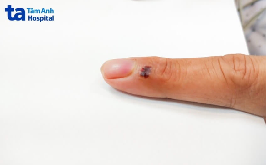 Cứu sống người bệnh nhiễm “vi khuẩn ăn thịt người”