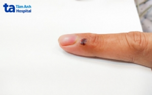 Cứu sống người bệnh nhiễm “vi khuẩn ăn thịt người”