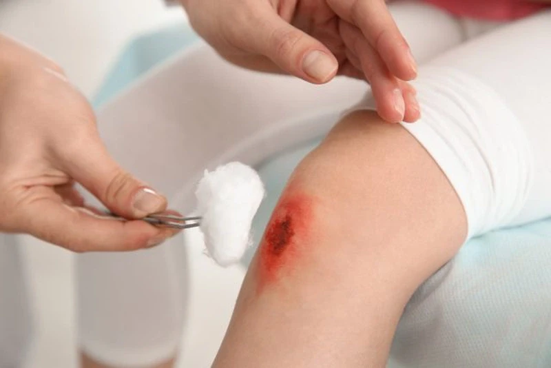 Tại sao không nên dùng cồn cho vết thương hở?